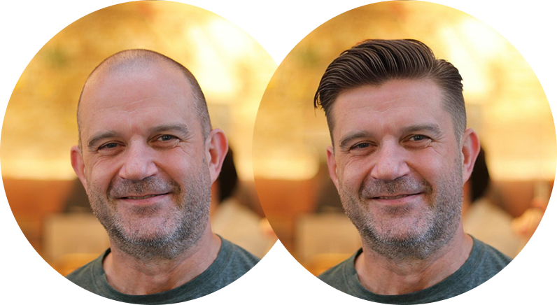 AI hair transplant simulator